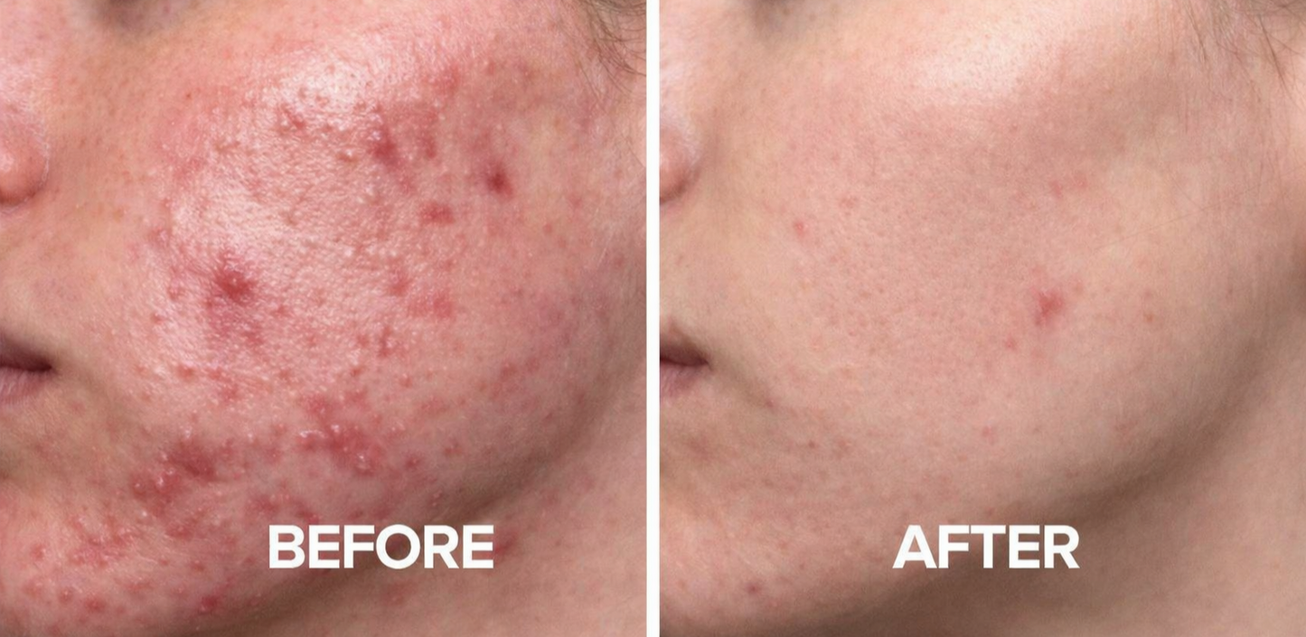 GlowPulse™ High Frequency Acne Wand – Skin Tightening & Anti-Aging Device