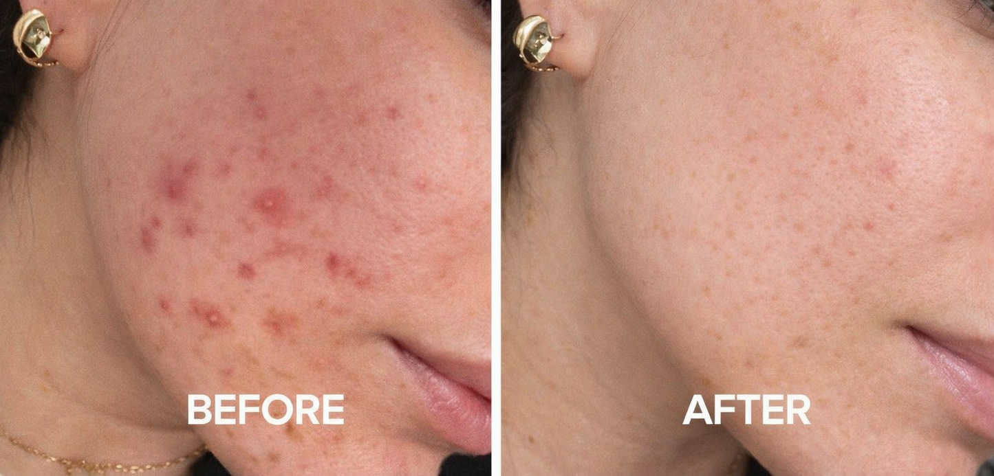 GlowPulse™ High Frequency Acne Wand – Skin Tightening & Anti-Aging Device