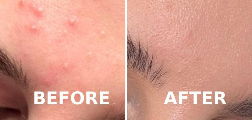 GlowPulse™ High Frequency Acne Wand – Skin Tightening & Anti-Aging Device