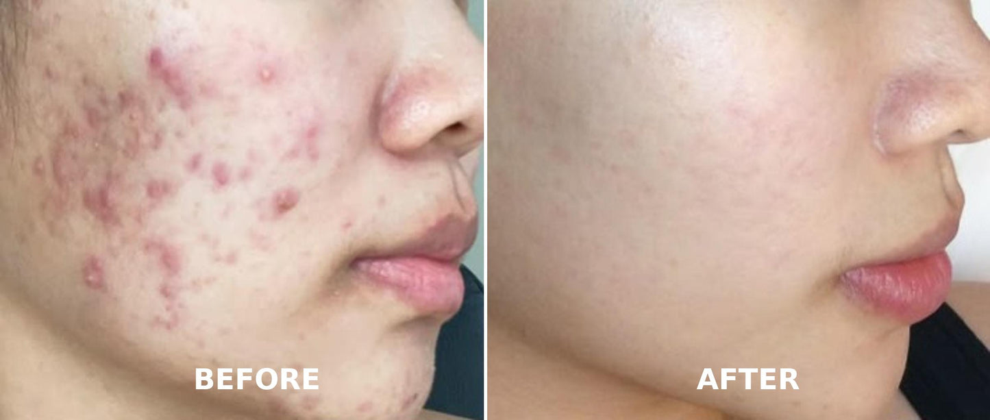 GlowPulse™ High Frequency Acne Wand – Skin Tightening & Anti-Aging Device