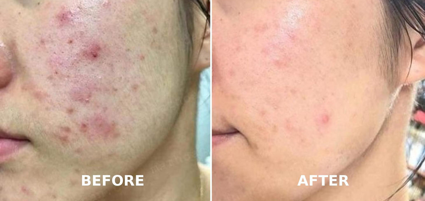 GlowPulse™ High Frequency Acne Wand – Skin Tightening & Anti-Aging Device